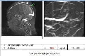 Đau đầu 4 ngày, đến viện mới phát hiện mắc thể đột quỵ não đặc biệt  第1张