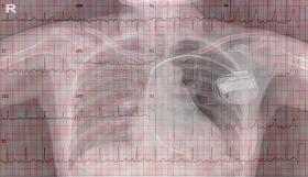 Cứu bệnh nhân người Úc bằng kỹ thuật đặt máy tái đồng bộ nhịp tim